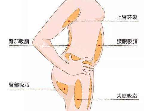 环吸抽脂有什么风险和后遗症？风险和后遗症这里了解