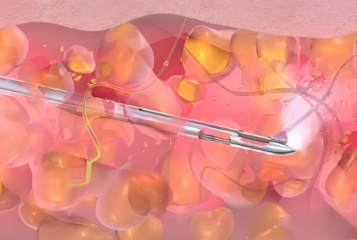 水动力吸脂手术效果怎么样？适合部位、维持时间及真实术后反馈整理