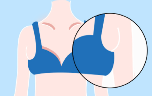 副乳抽脂多久可以看出效果？副乳抽脂做完几天能见人？亲测消肿全过程！