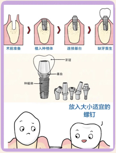 广医二院种植牙多少钱？三位患者的种牙费用与体验实录