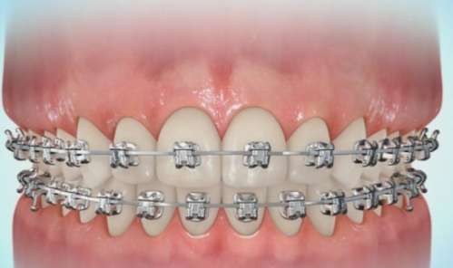 牙齿矫正