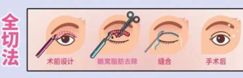 成都徐敦双眼皮案例曝光！医生做的自然吗？细节附上