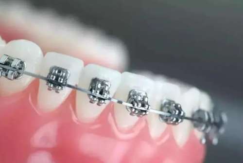 牙齿矫正