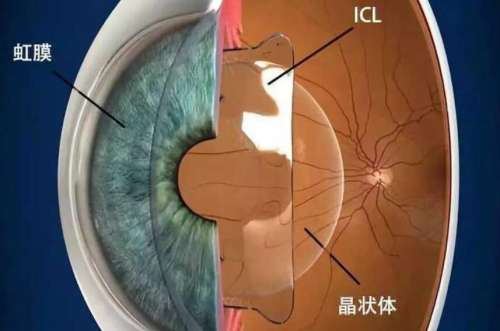 ICL晶体植入术
