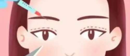 双眼皮
