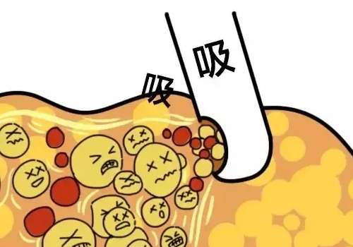 吸脂7.jpg