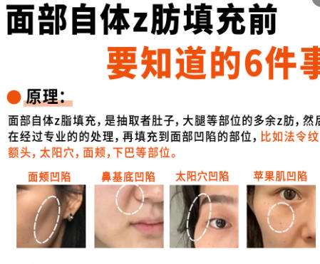面部填充