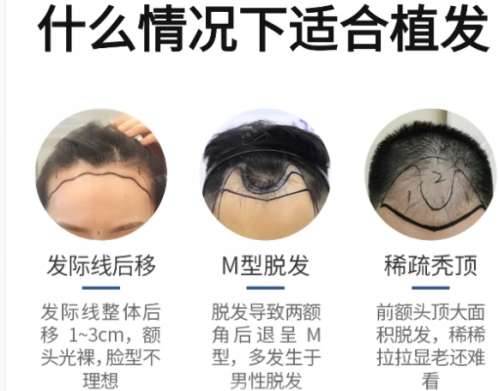 植发
