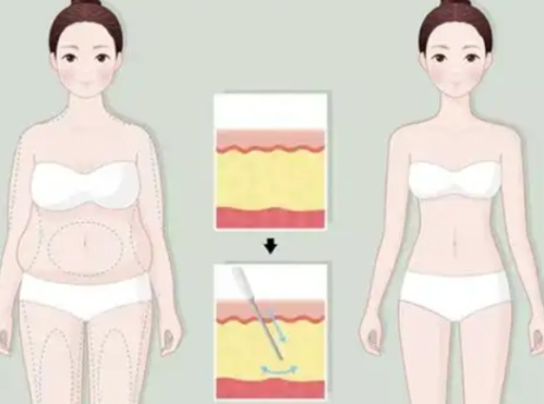 北京八大处抽脂手术费用，腰腹大腿手臂不同部位收费范围