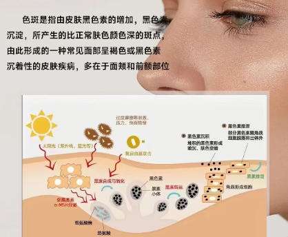 祛斑
