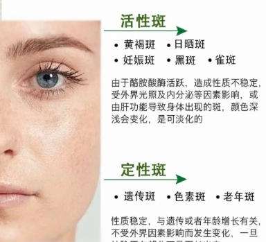 祛斑