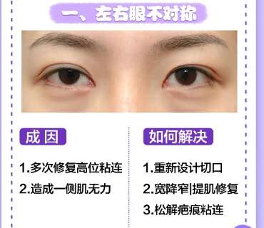 双眼皮修复 双眼皮修复