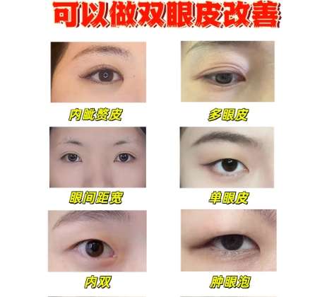 双眼皮