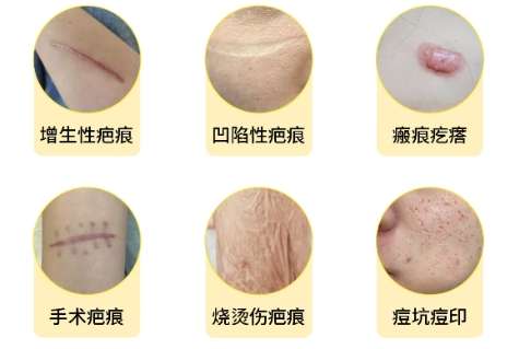 祛疤 祛疤