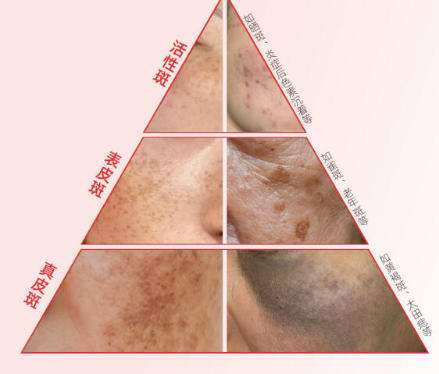 祛斑