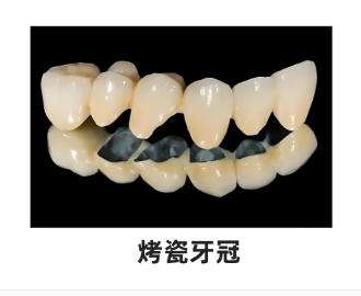 烤瓷牙 烤瓷牙