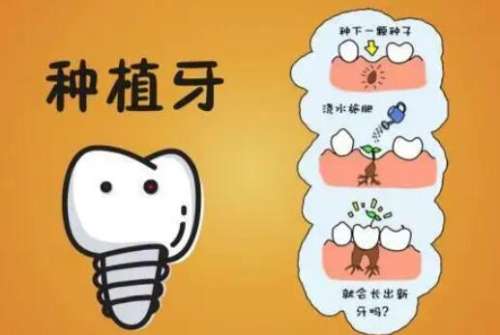 牙齿种植 牙齿种植