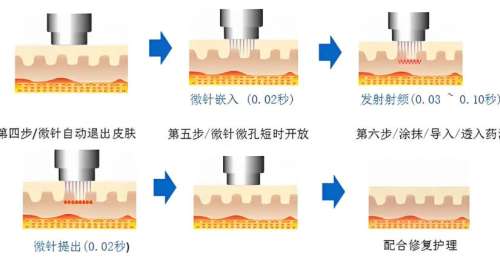 黄金微针 黄金微针