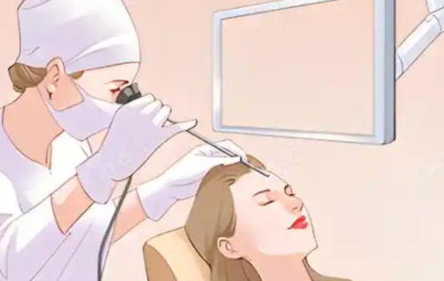 内窥镜提升和颈膜折叠到底好不好？医生和就诊者两个视角的评价